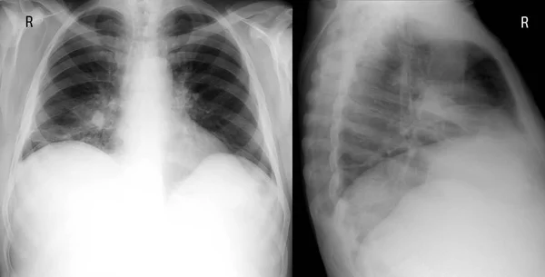 Röntgenlunge. zeigt ein großes Infiltrat im Mittellappen der rechten Lunge. Lungenentzündung. Front- und Seitenüberstand — Stockfoto