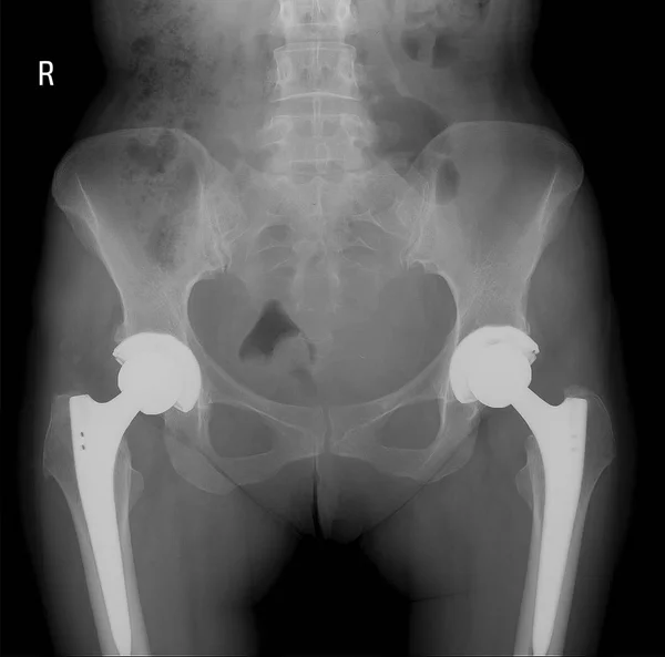 Imagen de rayos X de articulaciones de cadera con cabeza de implante de reemplazo ortopédico de cadera y tornillos en esqueleto humano . — Foto de Stock