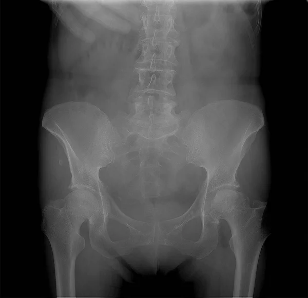 Röntgen röntgenfelvétel a medence, a osteochondropathy, a bal combcsont fej — Stock Fotó