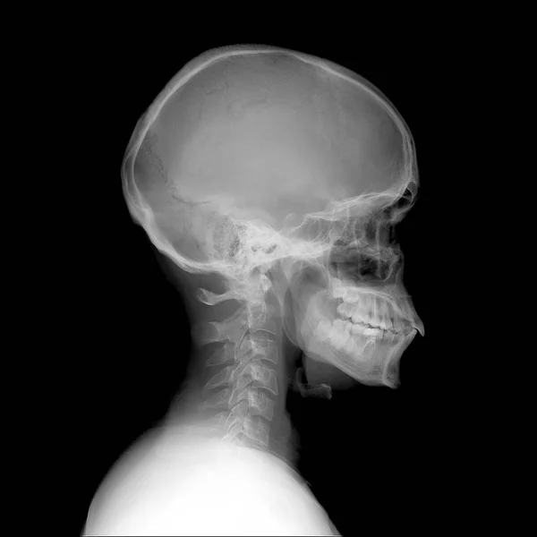 RTG czaszki i kręgosłupa szyjnego. Sagital widok normalny. — Zdjęcie stockowe