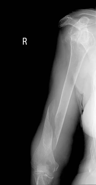 Spiral şeklinde kırık omuz çıkığı baş ile x-ışını.