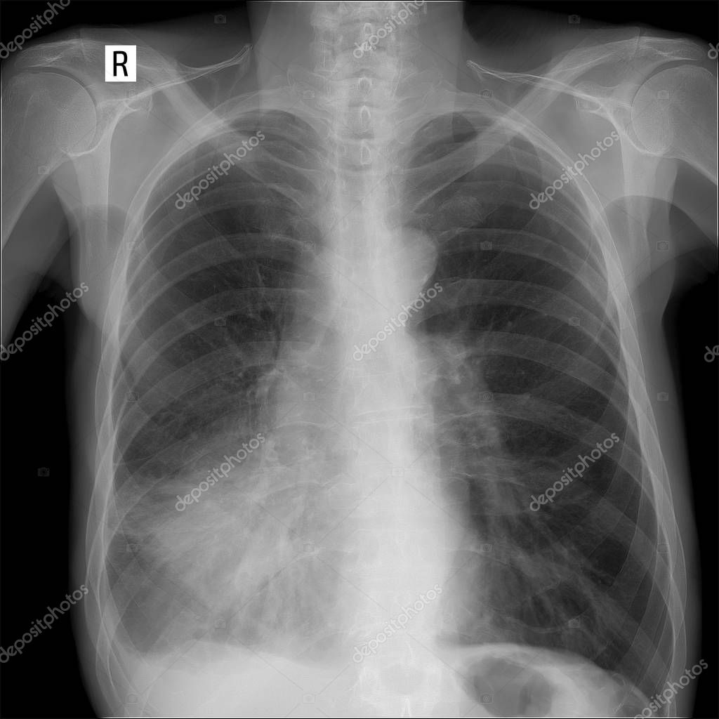X-ray lung. showing a large infiltrate in the middle lobe of the right