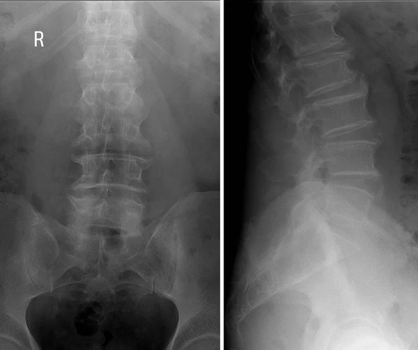 Radiografía de la columna lumbar. Espondilosis deformante. proyecciones laterales y sagitales . —  Fotos de Stock