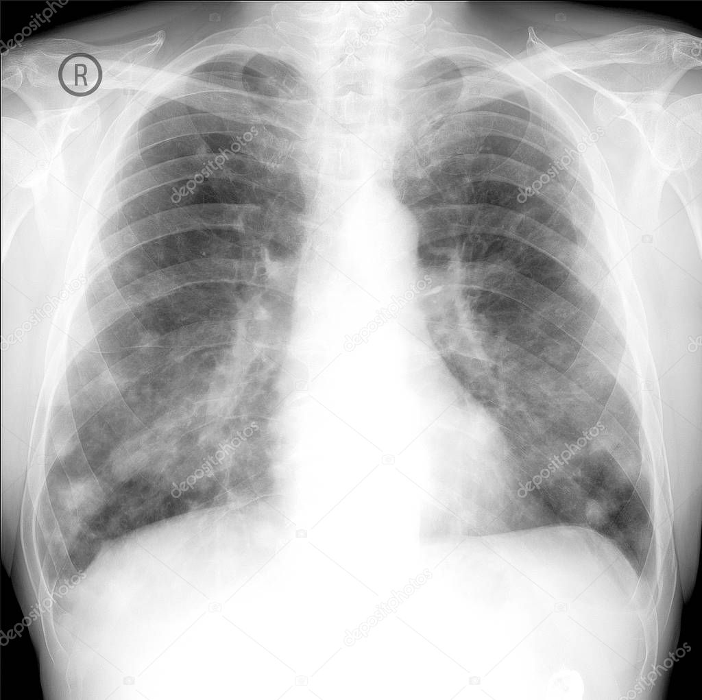 x-ray show lung cancer. Multiple lung metastases.