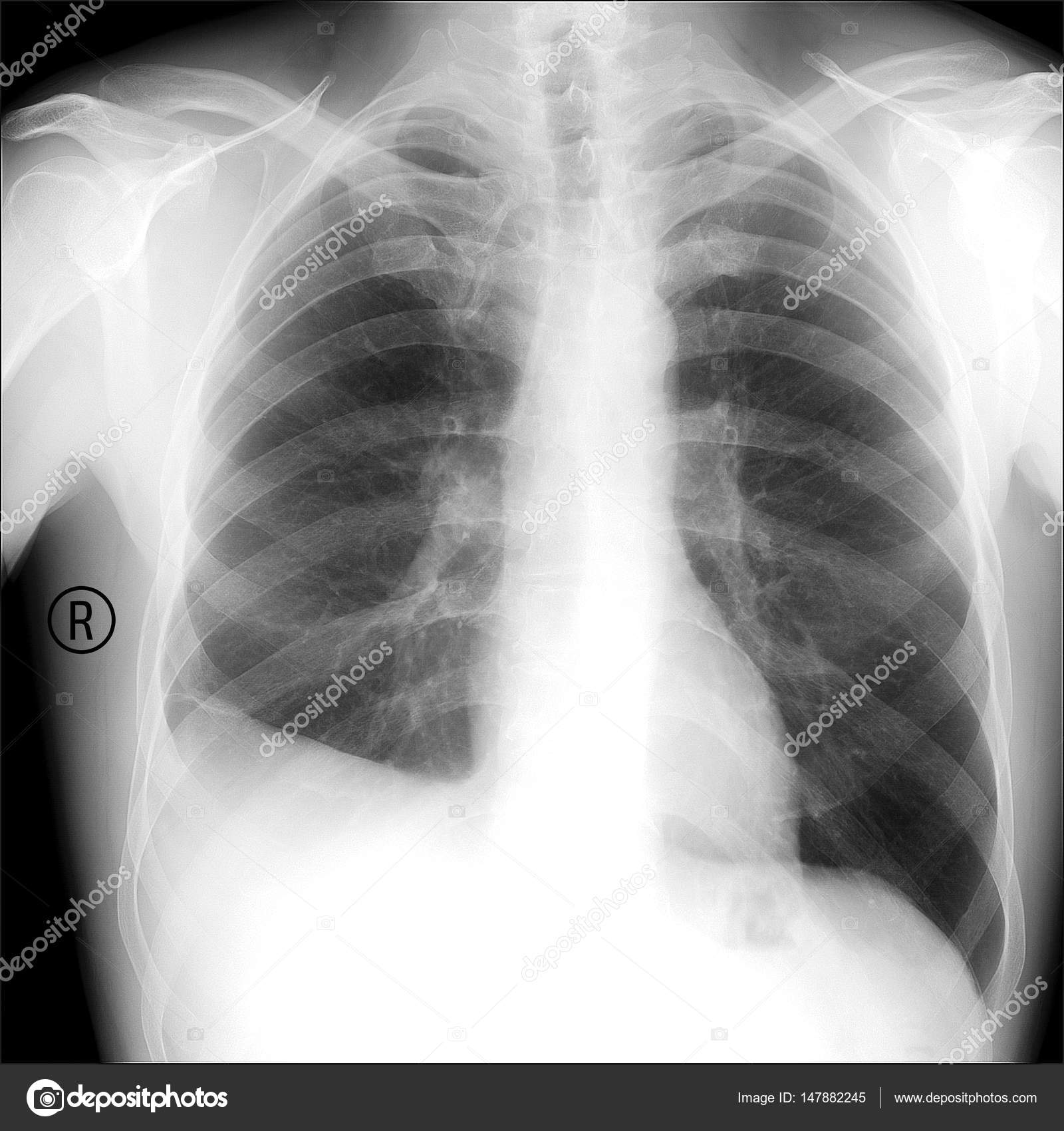 胸腔X光影像教學之一：肋膜積液 (Pleural effusion)