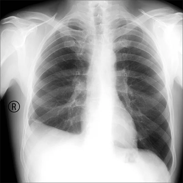 RTG pacienta s nemocí pleuritida. Zánět kolem plic. — Stock fotografie