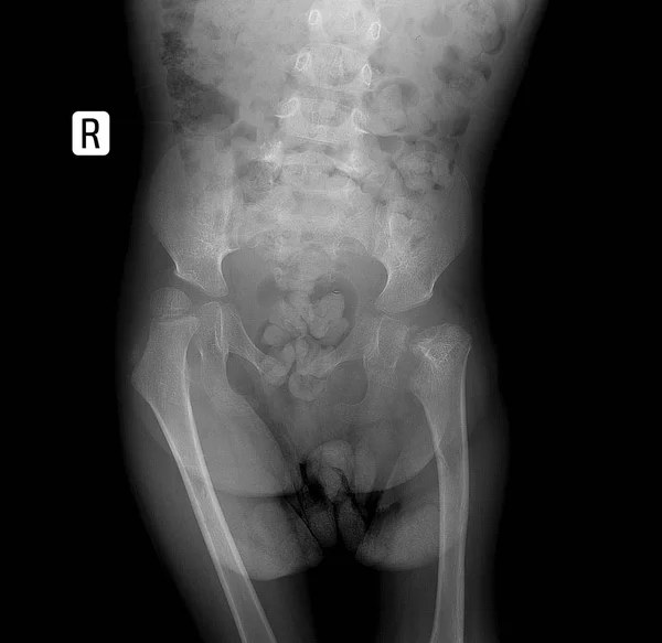 Radiografía de la pelvis con osteocondropatía de la cabeza femoral en un niño . — Foto de Stock