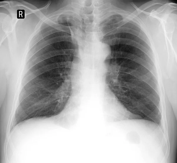 X-ışını akciğer. Takıma giren payına düşeni unpaired ven.