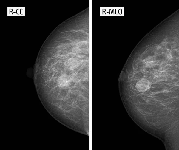 x-ışını resim mamografi. 6.Mastopati.