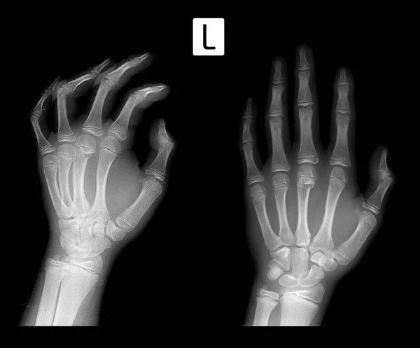 X 선 metaphysis 3 손바닥 뼈 뼈의 골절. — 스톡 사진
