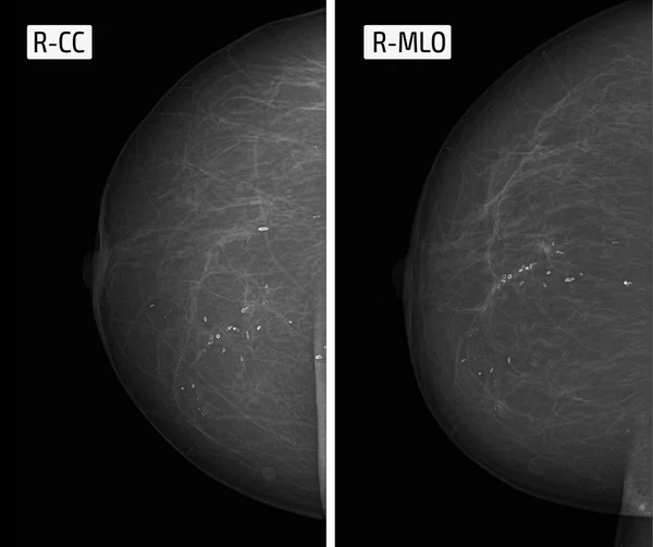 x-ışını resim mamografi. Yuvarlak Calcinates