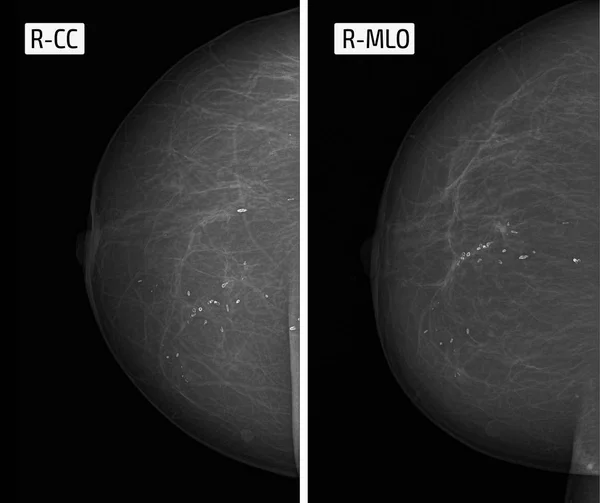 X-ray foto mammografie. Calcinates afgerond — Stockfoto