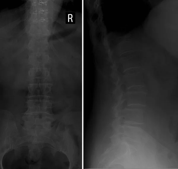 Columna lumbar de rayos X. Osteocondrosis, espondilosis, antelistesis . —  Fotos de Stock