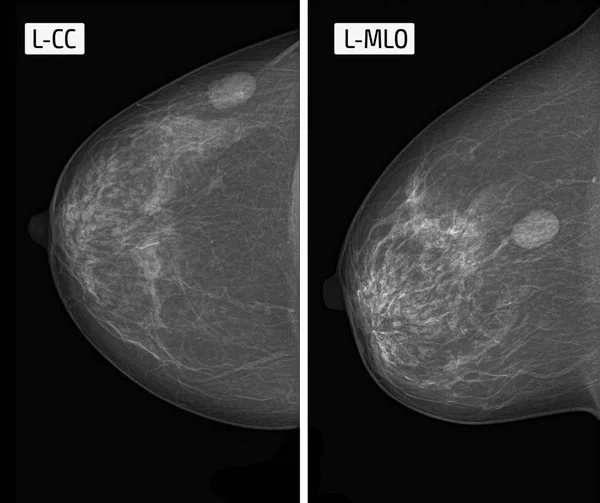 x-ışını resim mamografi. Fibrom.