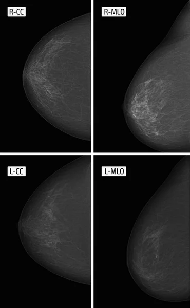 Zdjęcie rentgenowskie mammograficzne. Kalcynaty. Guz. — Zdjęcie stockowe