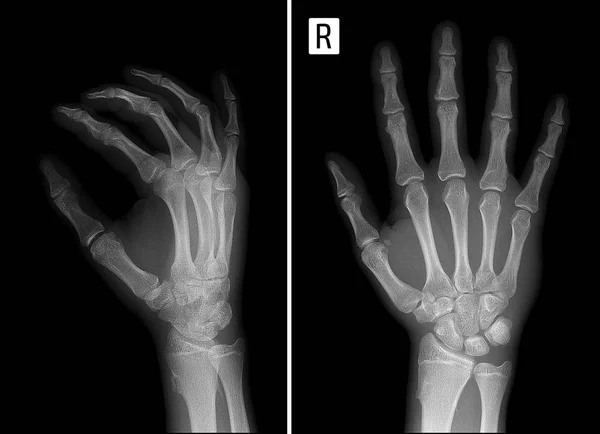 X-ray wielu kostniakochrzęstniaki ręki. — Zdjęcie stockowe
