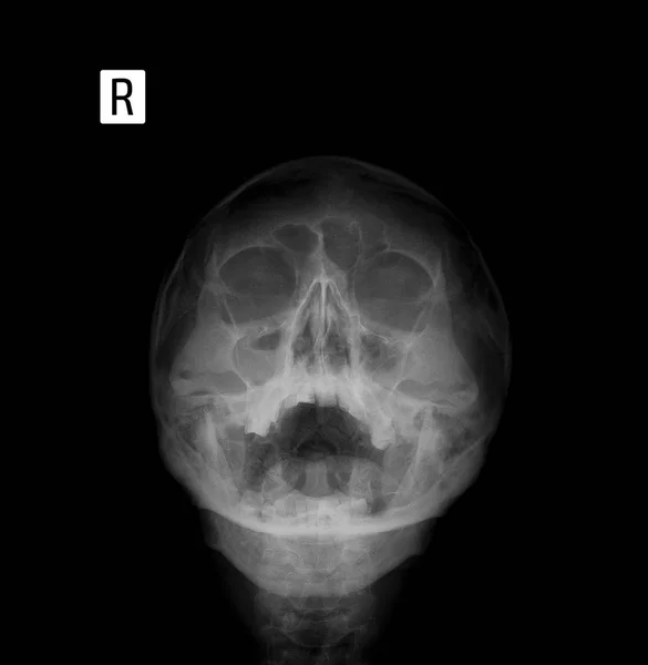 X 射线胶片为正面人脸，鼻子-下巴投影。鼻窦炎. — 图库照片