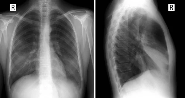 X-ışını akciğer. büyük bir infiltrat sağ akciğer orta LOB içinde gösterilen. Zatürree. ön ve yanal projeksiyon