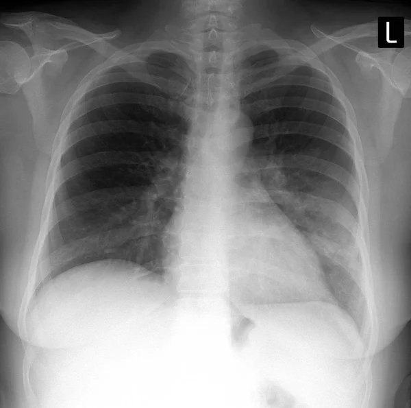 Rentgenové plic. Zobrazeno velké infiltráty v levé plíci. Zápal plic. — Stock fotografie