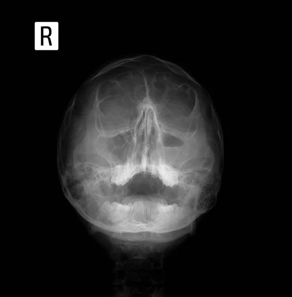 X 射线胶片为正面人脸，鼻子-下巴投影。鼻窦炎. — 图库照片