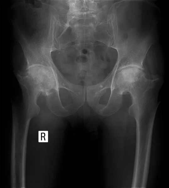 Rayos X. osteoartritis deformante bilateral de las articulaciones de la cadera . —  Fotos de Stock
