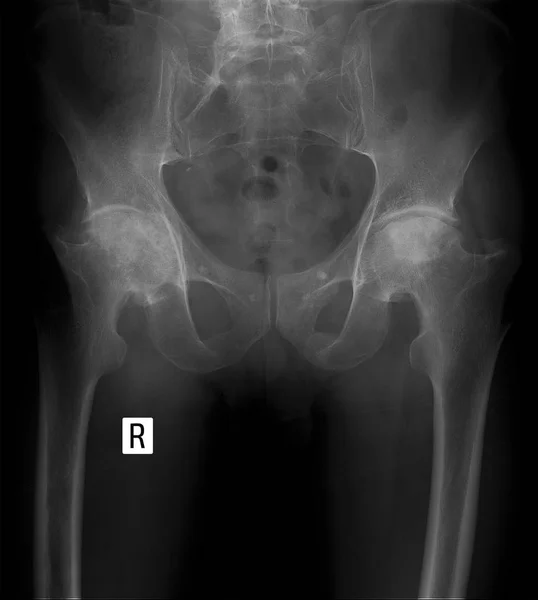 Рентгенівський знімок. Двосторонній деформаційний остеоартрит кульшових суглобів . — стокове фото