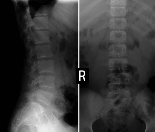 Radiografía de la columna lumbar. Cuerpo deformado en forma de cuña de la vértebra . —  Fotos de Stock