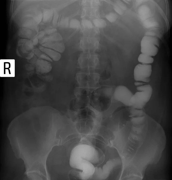 Radiografía de las partes inferiores del tracto gastrointestinal (GI). Relleno apretado. Dolihosigma, diverticulosis . — Foto de Stock