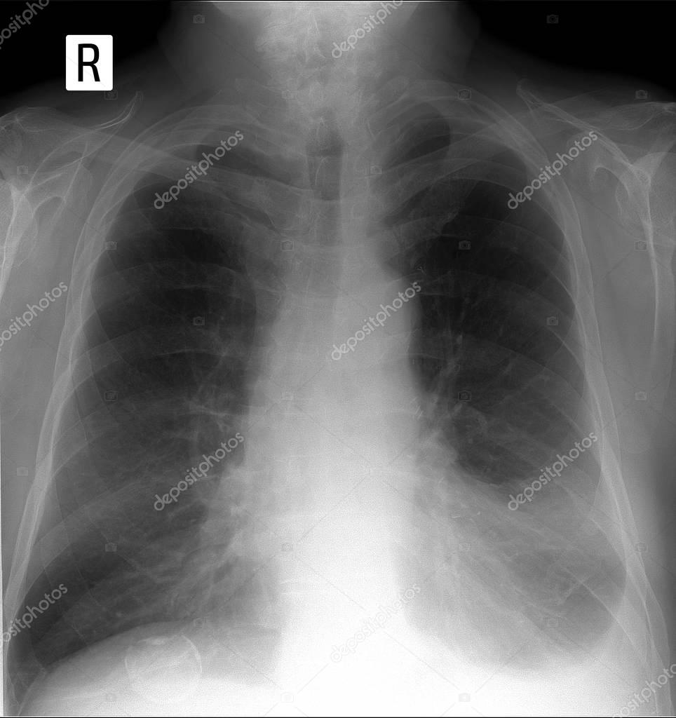 White Spots On Lung X Ray