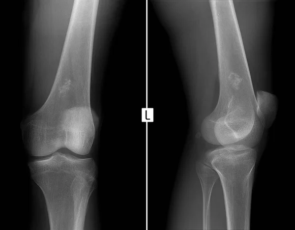 RTG levého kolenního kloubu. Ewing sarkom, lymfom, myelom stehenní kosti. — Stock fotografie