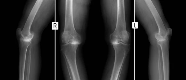 膝関節の x 線。変形性関節症の変形. — ストック写真