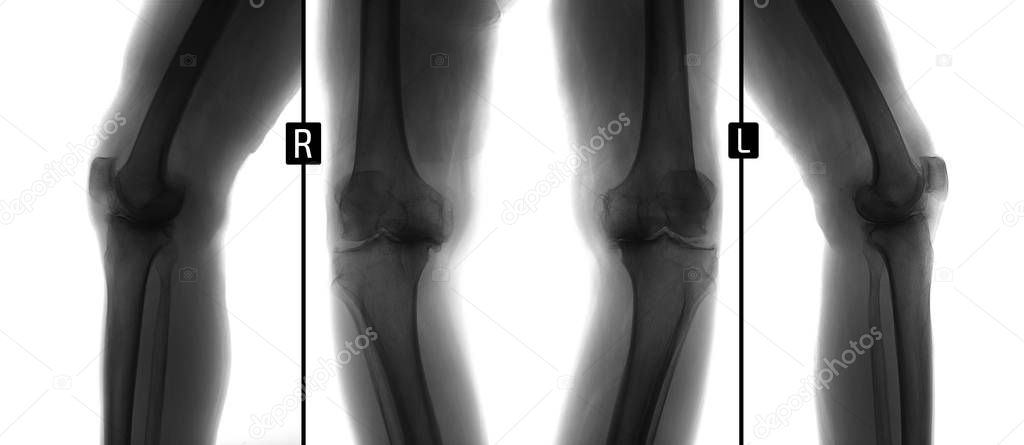 X-ray of knee joints. Deforming osteoarthritis. Negative.