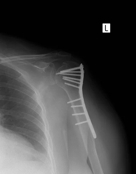 Røntgen på venstre skulder. Skulderbrudd med metall . – stockfoto