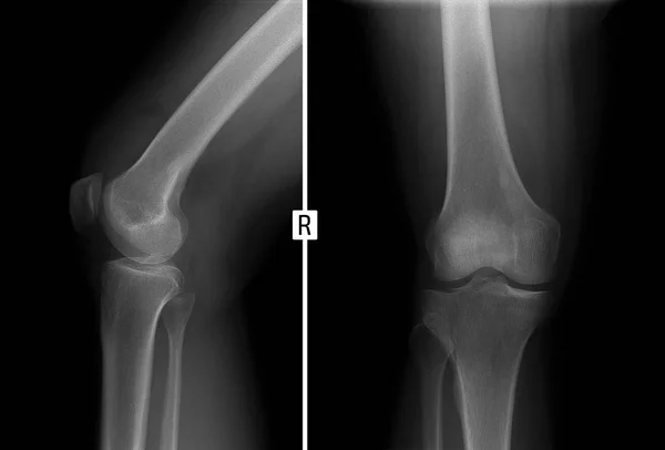 A jobb oldali térd ízületi X-ray. Törés, a sípcsont oldalsó condylus. — Stock Fotó