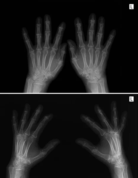 Röntgen a kezét. Ízületi arthrosis. — Stock Fotó