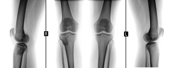 Rayos X de articulaciones de rodilla. Tumor de células gigantes de la tibia derecha. Negativo. . — Foto de Stock