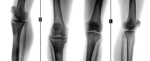 Diz eklemleri X-Ray. Osteomiyelit, şu tibial. Negatif.