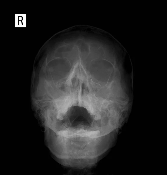 X 射线胶片为正面人脸，鼻子-下巴投影。受累. — 图库照片