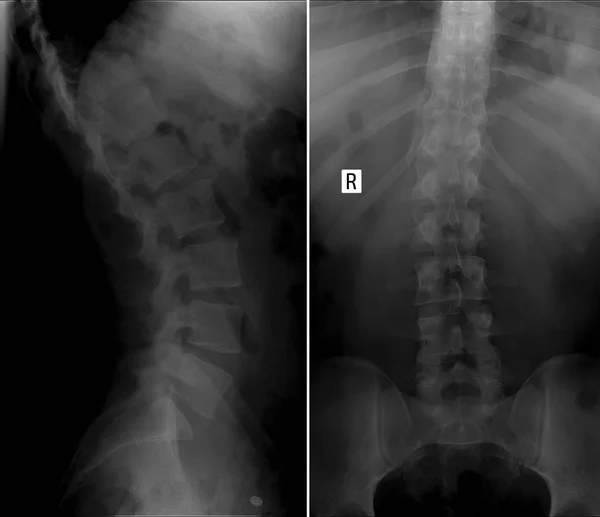 X-ray skolioza kręgosłupa lędźwiowego. — Zdjęcie stockowe