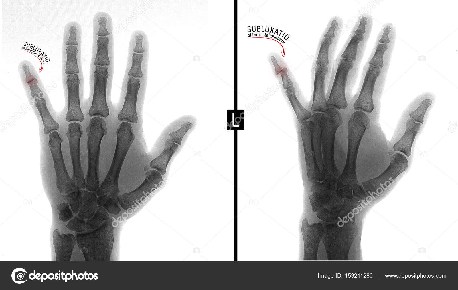 Xray of the hand. Shows the subluxation of the distal phalanx of the