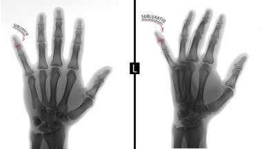 X-ray of the hand. Shows the subluxation of the distal phalanx of the fifth finger of the left hand. Marker. Negative. clipart