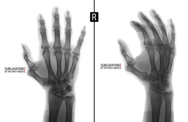 X-ray of the hand. Shows the subluxation of the proximal phalanx of the first finger of the right hand. Marker. Negative. clipart