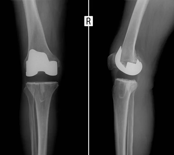 X-ışını ortak sağ dizi. Sağ diz eklem artroplastisi.