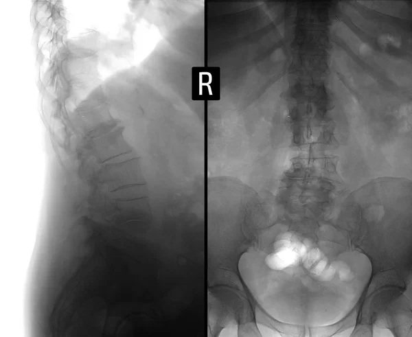 Radiografía Espondilosis deformante de la columna lumbar, Antelistesis. Negativo. . — Foto de Stock