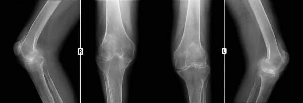 X-ışını diz eklem. Artrit progressiva deformans diz eklemlerin gösterir. Adam 38 yaşında.
