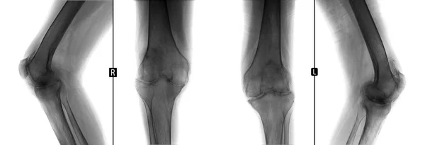 膝関節の x 線。膝関節の関節炎性変形性を示しています。38 歳の男です。否定的です. — ストック写真