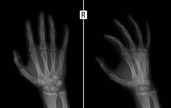 손의 x 선입니다. 오른쪽의 두 번째 손가락의 근 위 지 골의 골절을 표시. — 스톡 사진