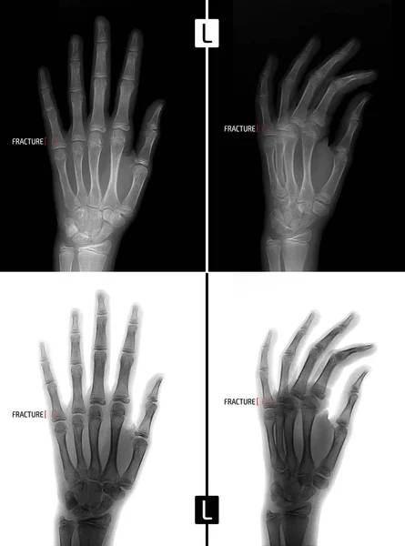 X-ray of the hand. Shows the Fracture of the base of the proximal phalanx of the fifth finger of the left hand. Marker. Positive. Negative. — Stock Photo, Image