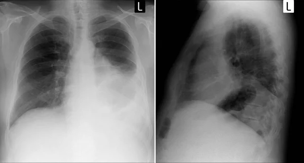 Raio-X: Lobectomia do lobo superior do pulmão esquerdo pós-câncer . — Fotografia de Stock