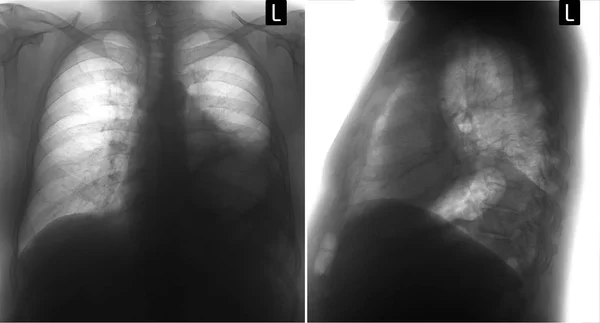 Röntgen-Lungen: Lobektomie des oberen Lappens der linken Lunge nach Krebs. negativ. — Stockfoto